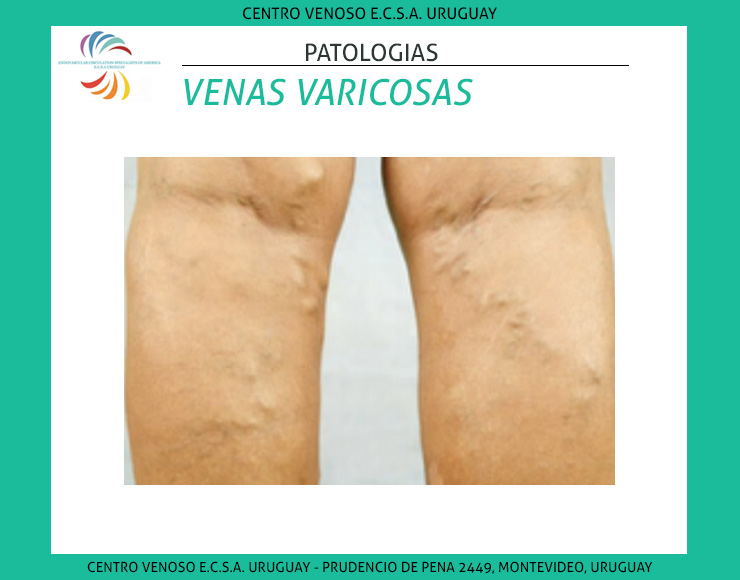 Venas Varicosas