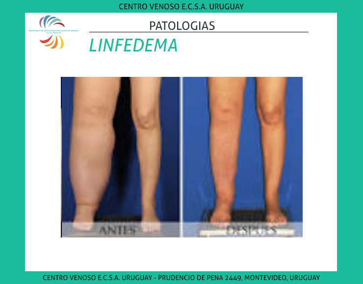 Linfedema