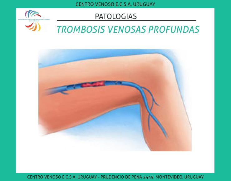 Trombosis Venosas Profundas